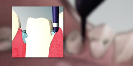 still from Animation how to use the 3M™ Astringent Retraction Paste video
