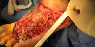 Diabetic foot infection with ulceration 
