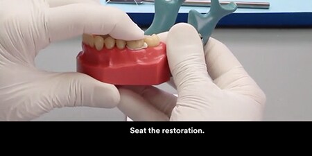 still from Cementation of a PFM crown with 3M ™ Ketac ™ Cem Plus Automix Cement video
