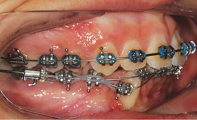 3M SmartClip SL3 Brackets