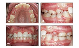 labially displaced unerupted maxillary canines