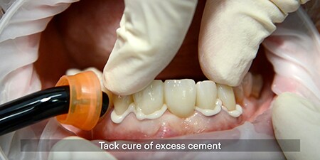 full-contour zirconia anterior bridge with self-adhesive resin cement
