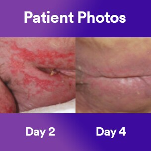 A side by side comparison of a patient on day one and day four.