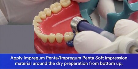 still from Monophase Technique with 3M™ Impregum™ Penta™/ 3M™ Impregum™ Penta™ Soft video 

