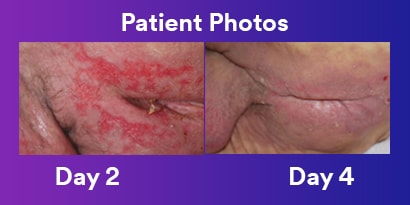 Patient wound progress comparison
