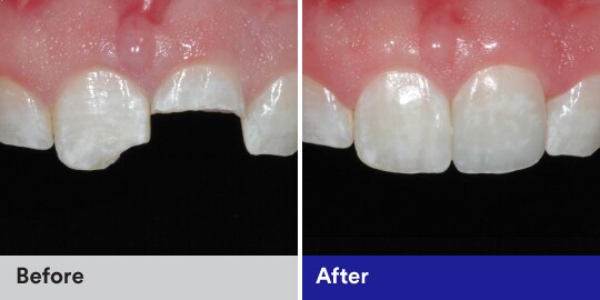 anterior restoration maxillary central incisors case study 
