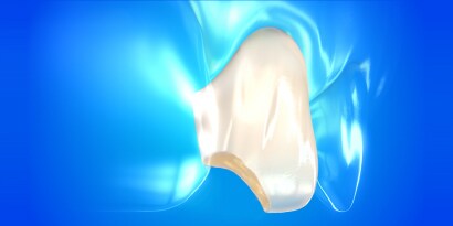 dental composite resin

