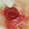 Peristomal Skin Damage