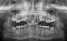 Successful treatment outcomes using the 3M™ Clarity™ ADVANCED brackets