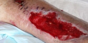 Surgical wound on leg
