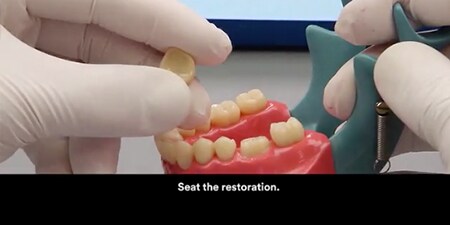 still from Cementation of a zirconia crown with 3M ™ RelyX ™ Unicem 2 Automix Cement video
