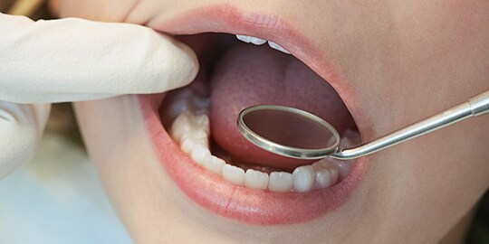 3m products for posterior restorations
