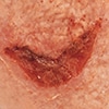 Medical Adhesive Related Skin Injury