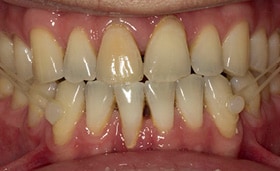 Improvement of the smile of a class III adult patient using customized lingual appliances