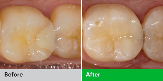 esthetic posterior composite restoration case study
