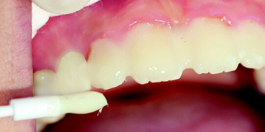 3m espe clinpro white varnish preventive procedure case study