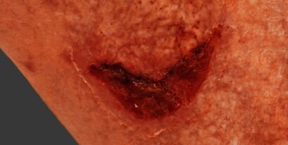 Medical Adhesive-Related Skin Injury
