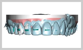A New Approach to Aligner Orthodontic Treatment