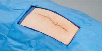 image of surgical incision
