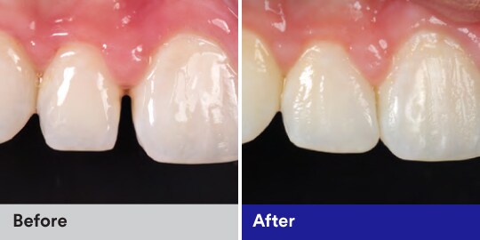 diastema closure case study with filtek Z350XT
