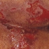 Pressure Ulcer Injury