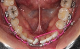 A hybrid approach: Maximizing esthetics in a complex occlusion