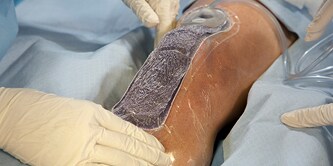  Prevena Peel and Place  on a knee
