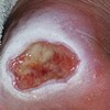 Periwound Skin Damage
