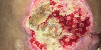 Pressure ulcer on foot
