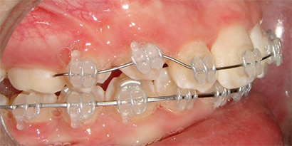 Treating the Mandibular Arch in the Deep Bite Patient with Ceramic Brackets