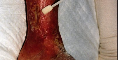 Periwound and peristomal skin damage
