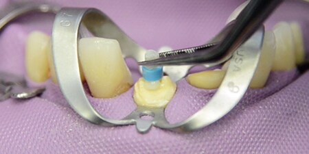 still from Success Simplified at work: Traumatic crown loss restoration with post and core video
