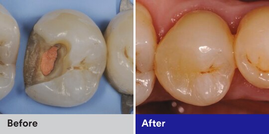 deep carious lesion case study with filtek one bulk fill
