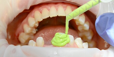 application of 3M™ Impregum™ 4 Super Quick Light Body
