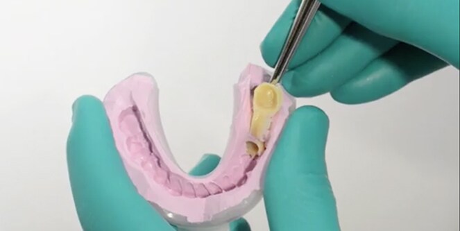 still from Clinical case using 3M™ Protemp™ 4 and 3M™ Imprint™ 4 Preliminary
