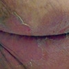 Incontinence Associated Dermatitis