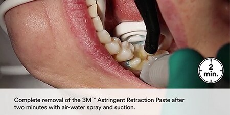 still from Clinical case using 3M™ Impregum™ Super Quick Polyether Impression Material video
