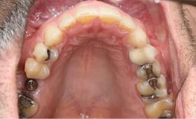 A patient’s teeth 4 months into orthdontic treatment