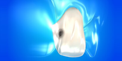 dental composite resin
